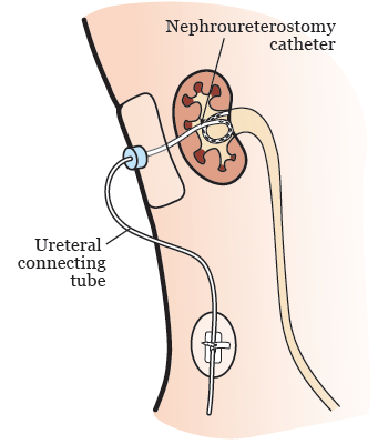 Nephroureterostomy catheter and ureteral connecting tube