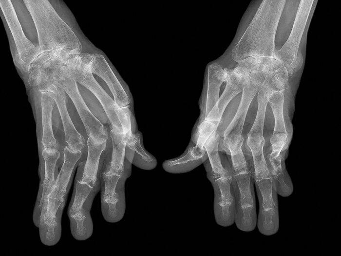 Rheumatoid arthritis among the elderly