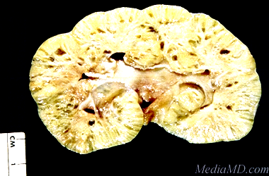 Image of a Kidney with many Cysts. Source: The Merck Manual