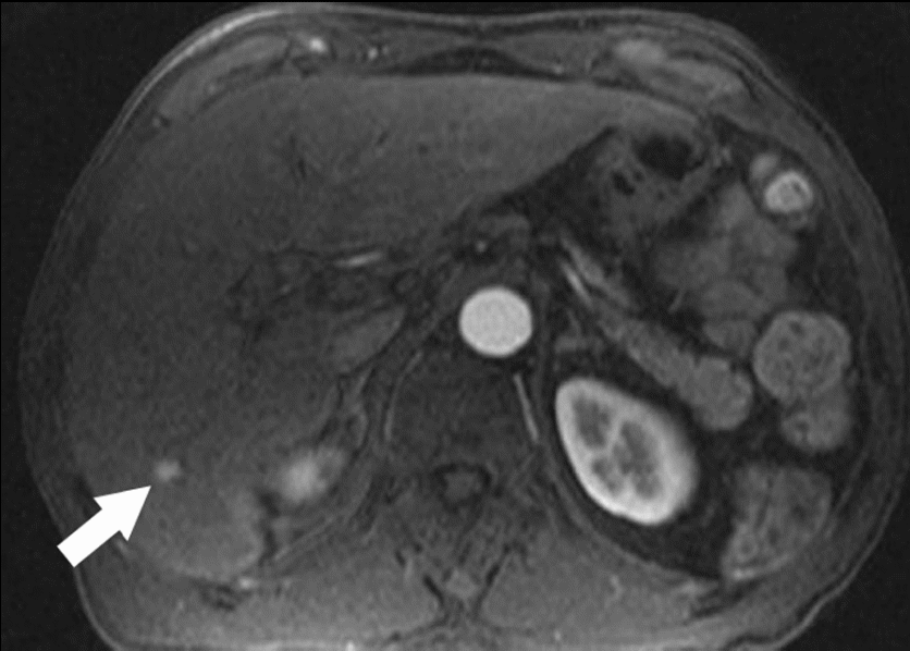 shows a 76-year-old man with hepatocellular carcinoma detected by MRI
