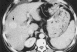 a hepatocellular carcinoma nodule identified by Lipiodol CT
