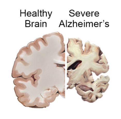 Alzheimer Disease: Causes and Treatment