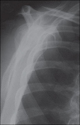 Transscapular or Y view of the proximal humerus