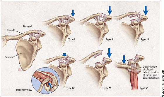 Acromioclavicular sprains and separations