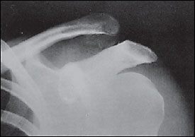 Type III acromioclavicular joint separation