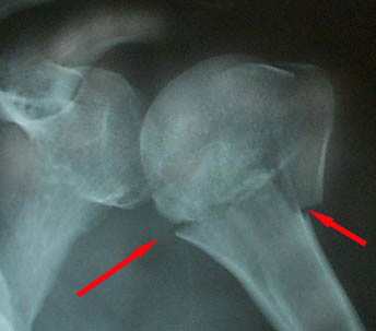 Fractures of the Shaft of the Humerus