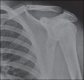 Minimally displaced mid-shaft fracture. Note that the scapula also is fractured