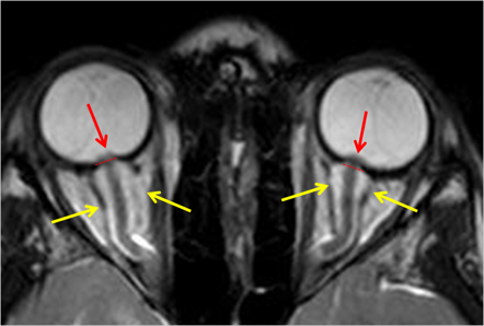 The yellow arrows are pointing to the swelling of glands that are causing the protrusion of the optic nerve heads