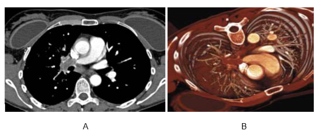(A) Two-dimensional multiplanar display, (B) particularly a coronal reformat, avoids this common pitfall