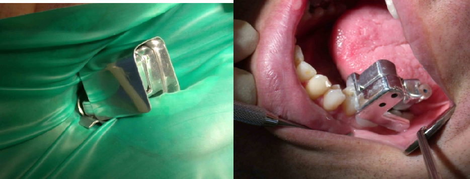 An endodontic microrobot (left), and in use (right) 