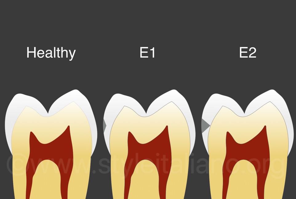 Evolution of Carious Tooth Enamel Damage 