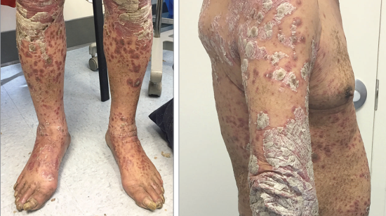 Clinical Picture of Psoriasis