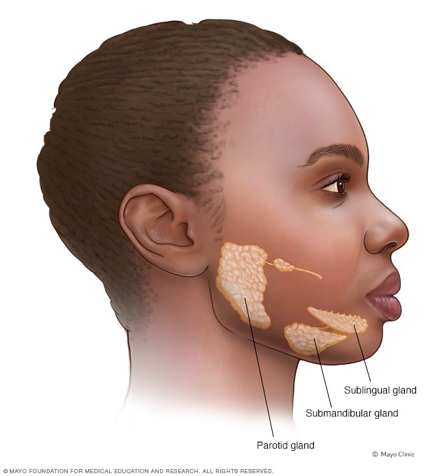 Salivary glands of mumps patient